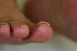 ①手術前人差し指側の爪が陥入し、痛みを生じています。